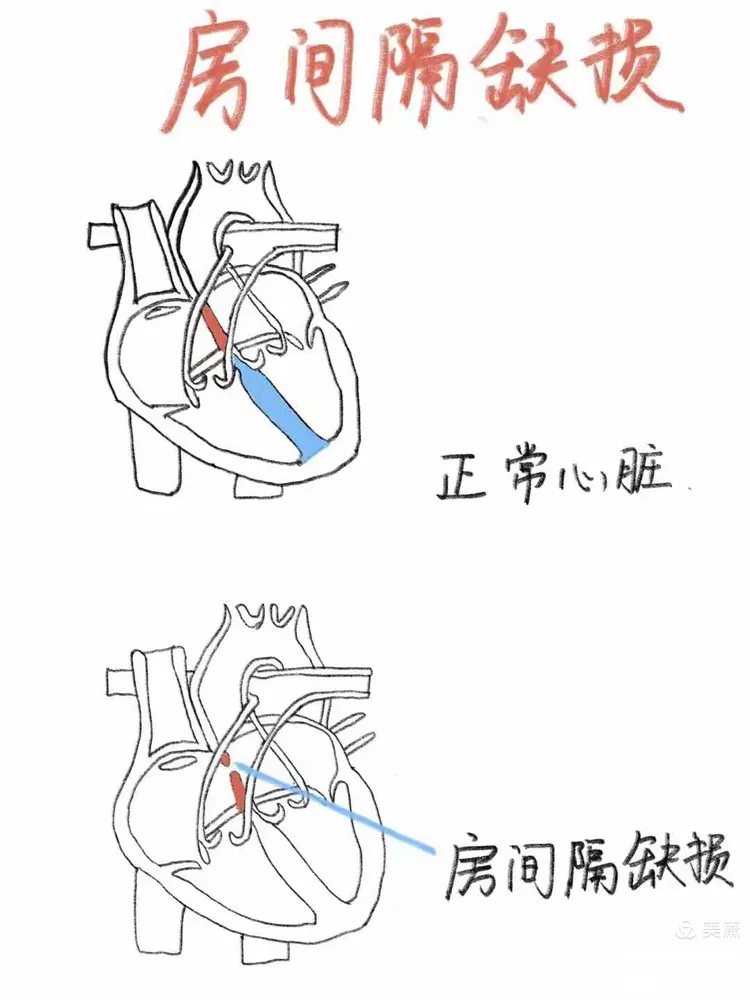 先天性心脏病-房间隔缺损